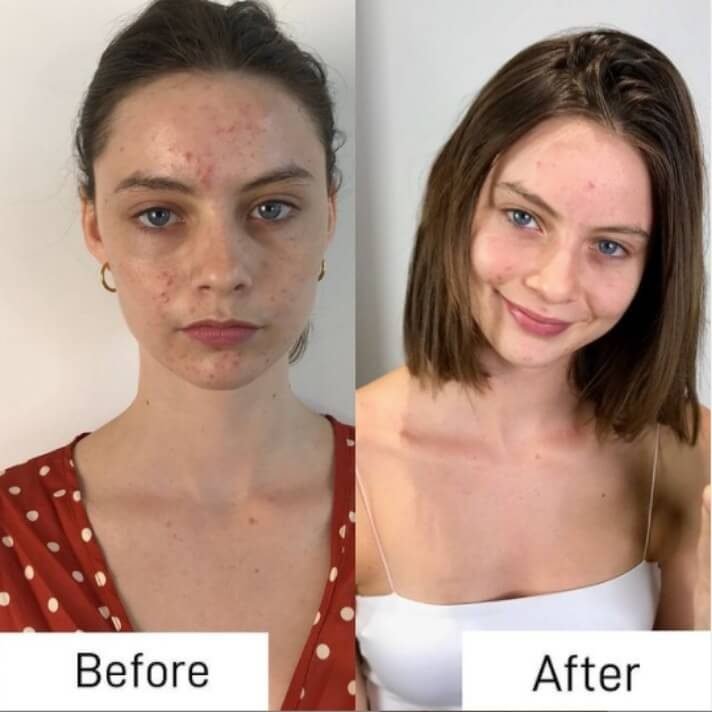 Acne_laser_results